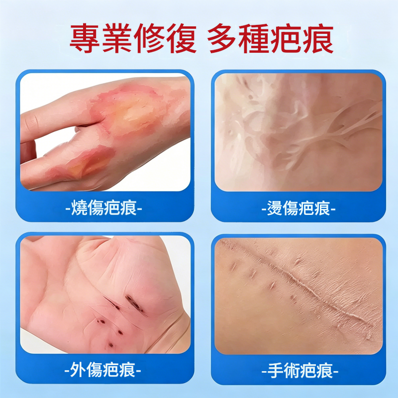 修正醫用矽酮祛疤膏，用於燒傷燙傷、手術疤痕、去除增生修復凝膠